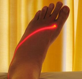 trattamento laser delle vene varicose sulle gambe