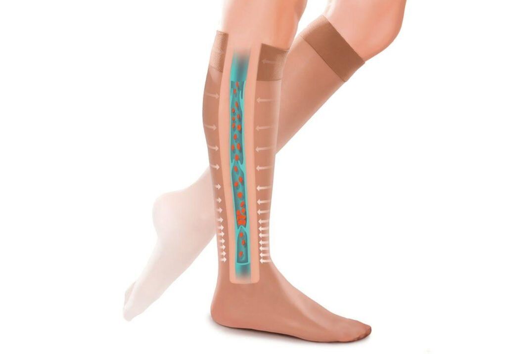 l'effetto delle calze a compressione sulle gambe con vene varicose