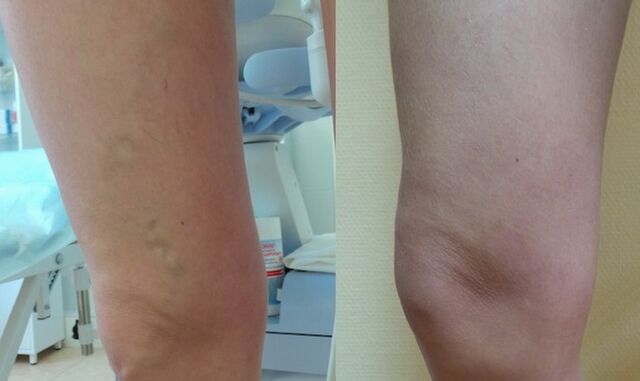 gamba prima e dopo il trattamento delle vene varicose reticolari