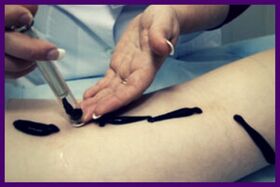 La procedura per il trattamento delle vene varicose con le sanguisughe (irudoterapia)