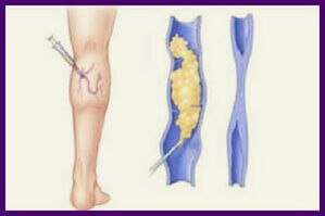 La scleroterapia è un metodo popolare per eliminare le vene varicose sulle gambe