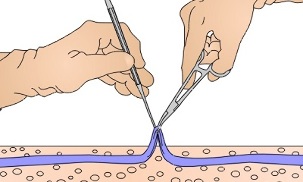 chirurgia per le vene varicose