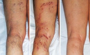 sintomi di vene varicose alle gambe