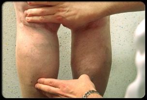 Il medico esamina le gambe con vene varicose