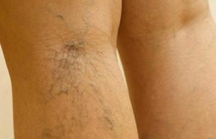 trattamento delle vene varicose sulle gambe