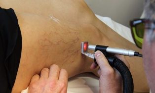 trattamento delle vene varicose laser