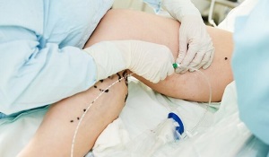 metodi di trattamento delle vene varicose sulle gambe nelle donne